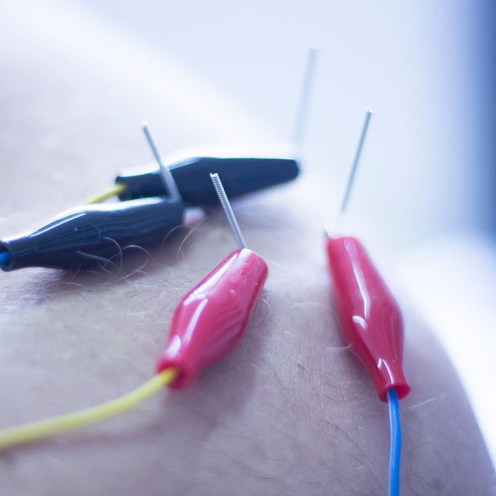 Osvaldo Castillo, Optimyze Physical Therapy, Miami, Florida, square, dry needling